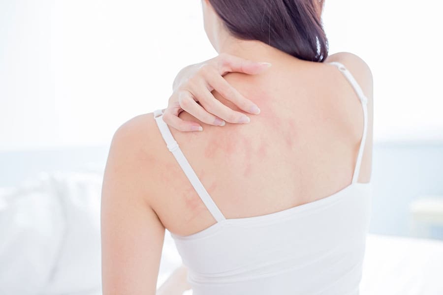 Autoimmune Disease and the Skin