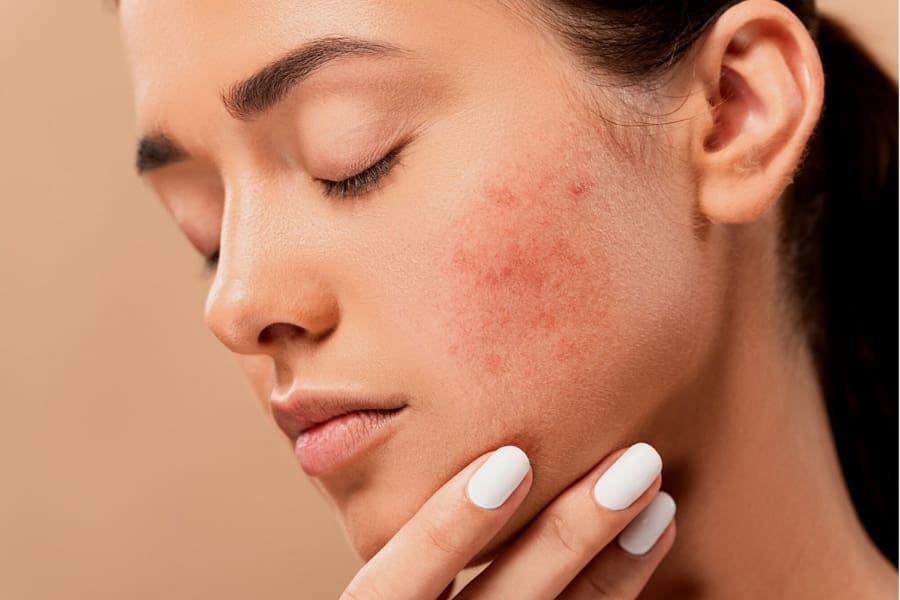 Cystic Acne Considerations: Pathology & Treatment