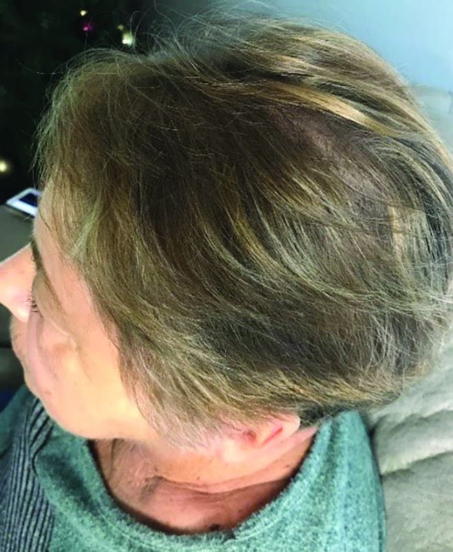 Light Duties: LED Light Therapy & Hair Regrowth