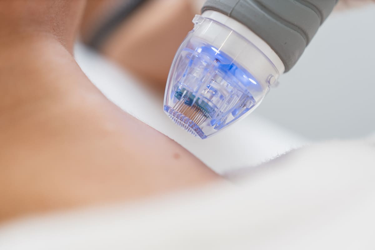Radiant Skin Revival: My Journey with Radio Frequency Microneedling 