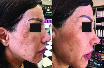 ClinicalPigmentationbefore