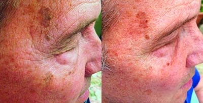 Dermyoungantiagingbefore