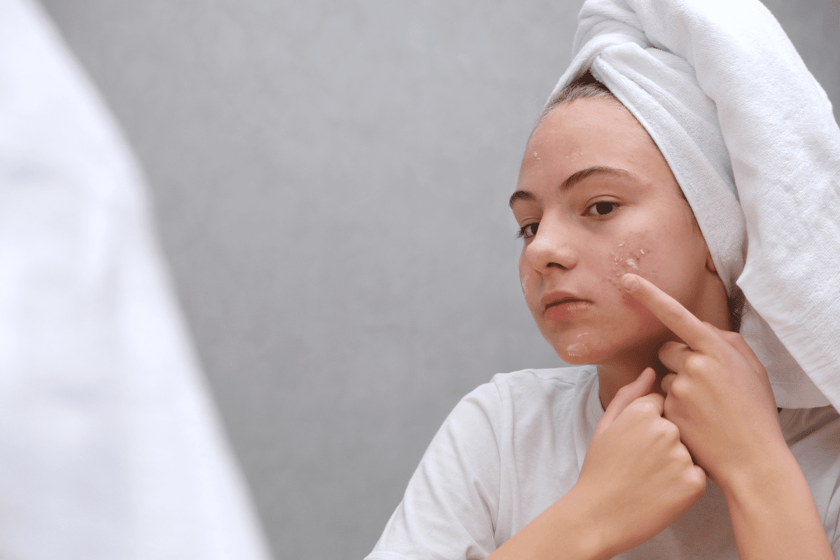 Breakouts & the Brain: Tackling Adolescent Acne 