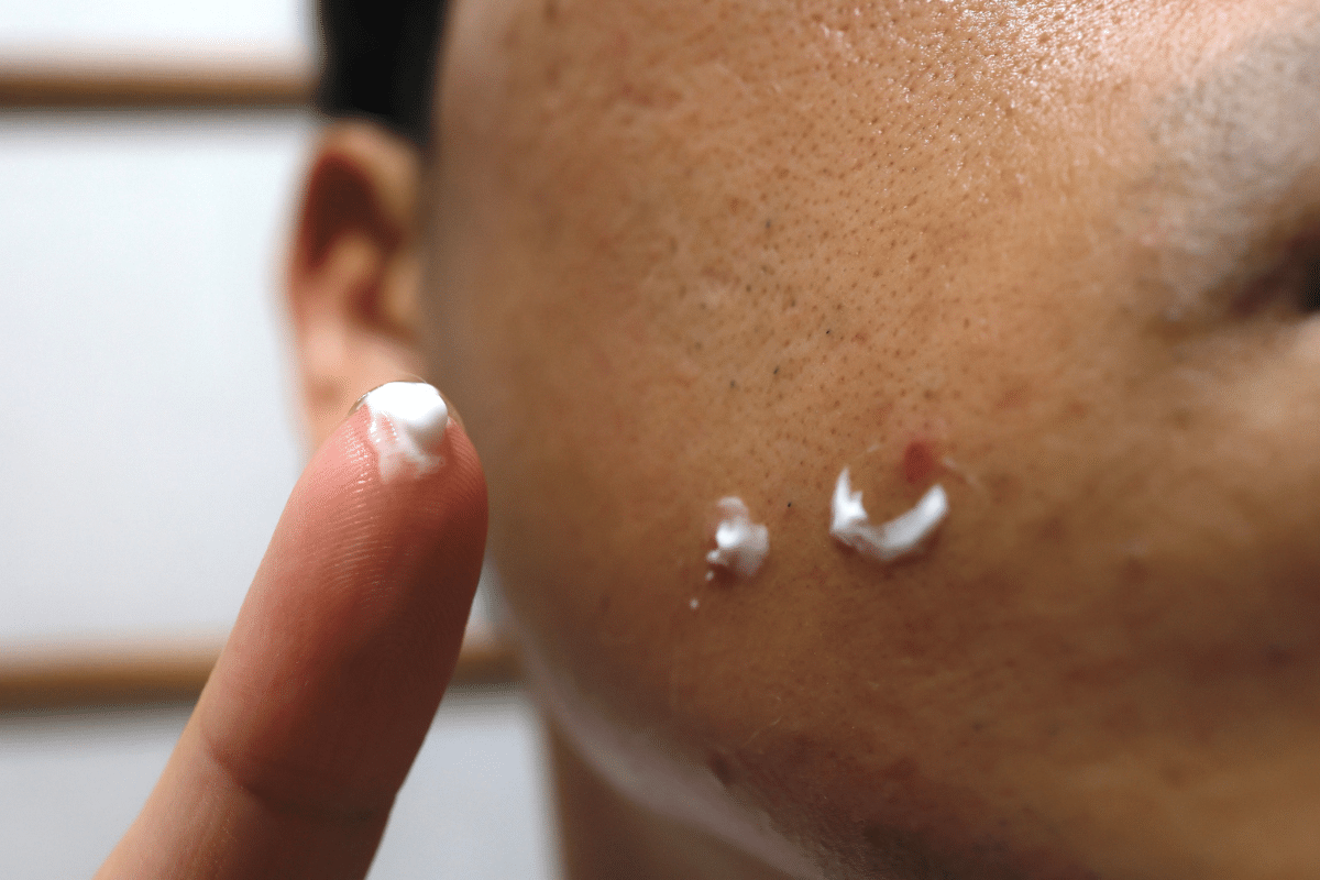 The Late Breakout: Testosterone, Sebum, & Acne After 30 
